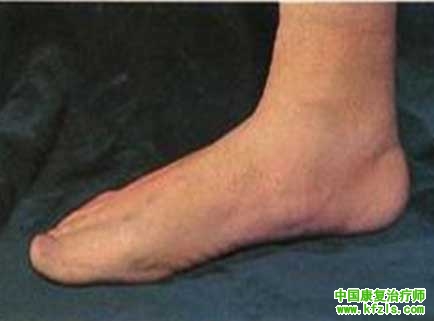 扁平足（Flat foot）
