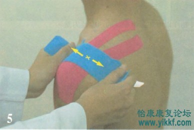 肩部伤害-软组织贴扎技术1