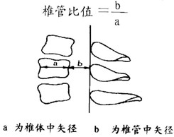 图1：发育性颈椎管测量示意图，b/a≤75%为椎管狭窄