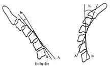 图2-a 颈椎节段性不稳定（椎间成角）测量方法：当b1或b2>11°视为不稳定