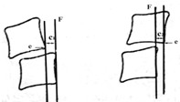 图2-b颈椎节段性不稳定（椎间滑移）测量方法：当c1+c2≥2mm视为不稳定
