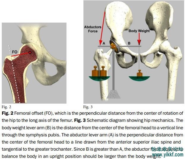 关节置换股骨形态学研究 2