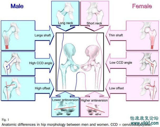 关节置换股骨形态学研究1 