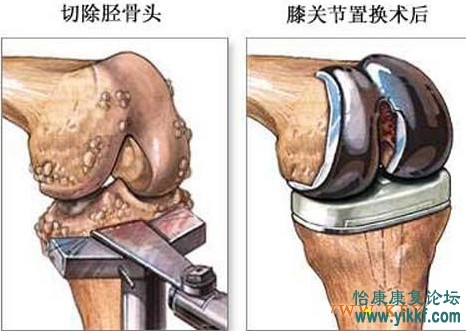 膝关节置换术后康复锻炼及注意事项