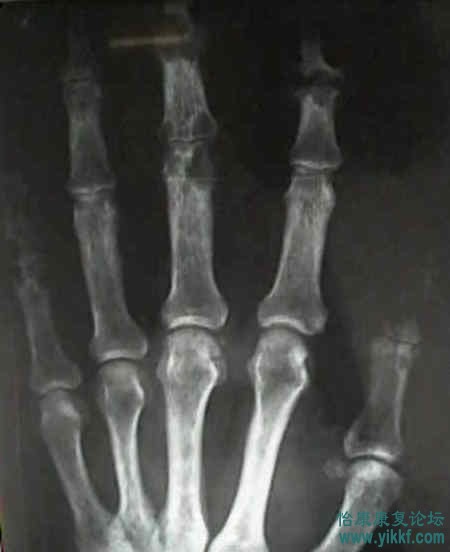 gout2.jpg