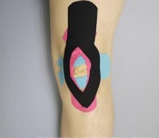 Kinesio Taping 康复肌内效贴法