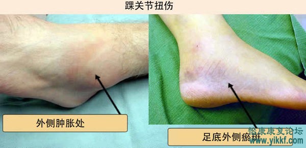 踝关节扭伤的机制与治疗