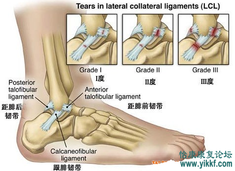 踝关节扭伤的机制与治疗
