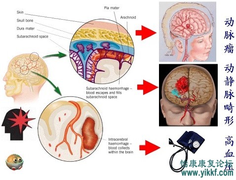 脑出血的常规治疗及康复治疗