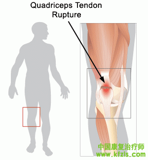 股四头肌腱断裂