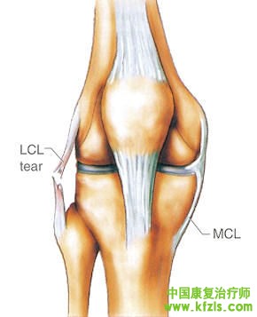膝关节外侧副韧带损伤