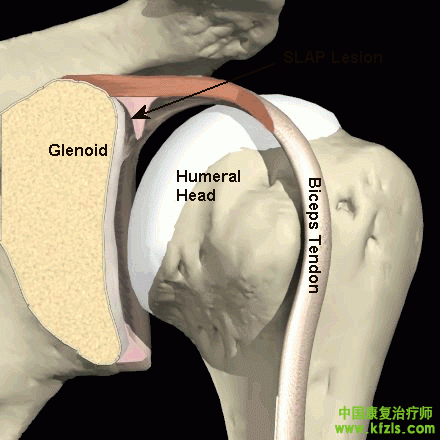 SLAP 损伤