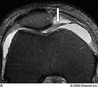 膝关节滑膜皱襞综合症（synovial plica syndrome）