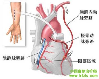 心脏手术后的康复治疗