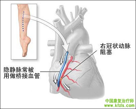 心脏手术后的康复治疗