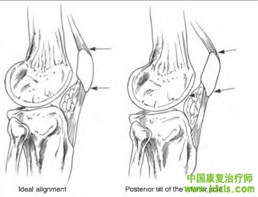 贴扎在髌股关节疼痛症候群（Patellofemoral pain synderom）中的应用