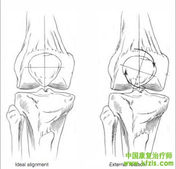 贴扎在髌股关节疼痛症候群（Patellofemoral pain synderom）中的应用