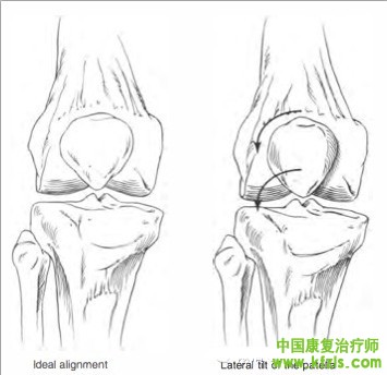 贴扎在髌股关节疼痛症候群（Patellofemoral pain synderom）中的应用