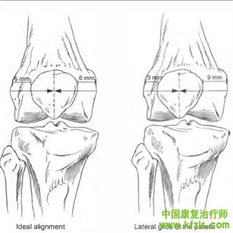 贴扎在髌股关节疼痛症候群（Patellofemoral pain synderom）中的应用