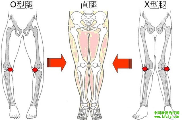 O型腿或X型腿引起关节炎的原因