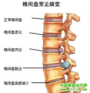 腰椎间盘突出的日常康复注意事项