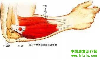 网球肘的康复治疗