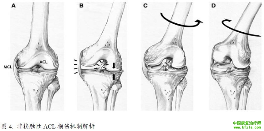 前交叉韧带损伤的防治