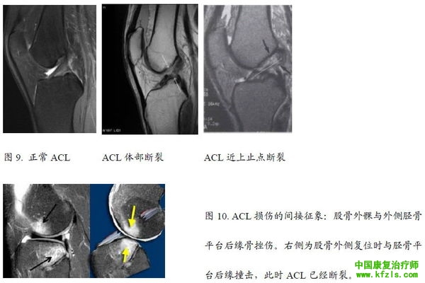 前交叉韧带损伤的防治