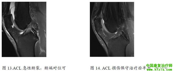 前交叉韧带损伤的防治