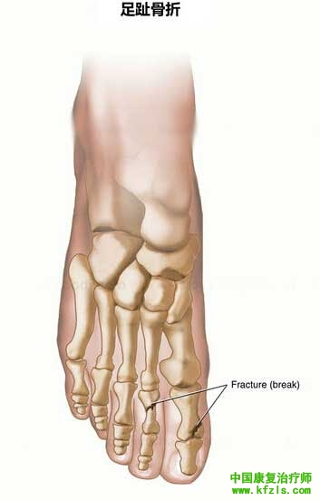 足趾骨折/创伤性关节炎康复练习法
