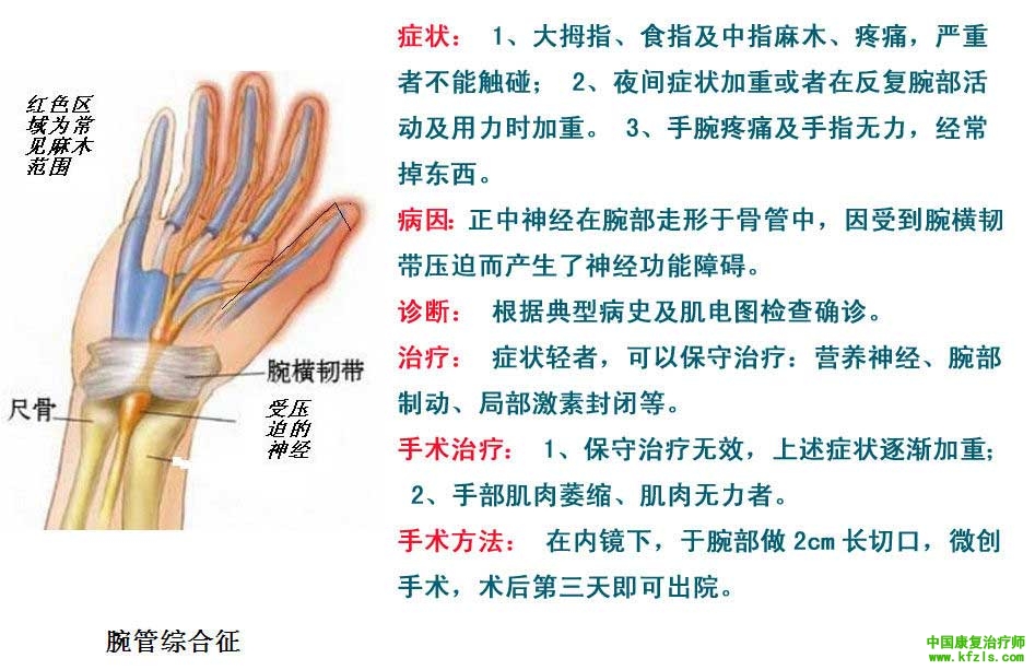 腕管综合症康复练习法