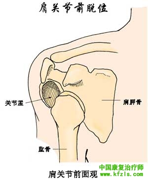 肩关节半脱位