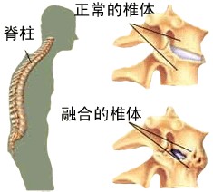 强直性脊柱炎