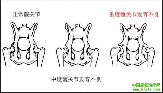 髋关节发育不良的分类