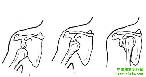 肩关节脱位