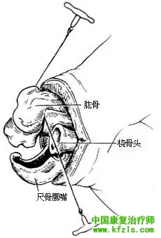 肘关节切除术（图解）