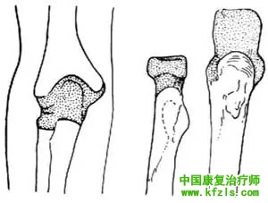 肘关节切除术（图解）