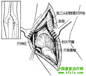 肘关节切除术（图解）