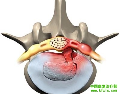 腰椎间盘突出