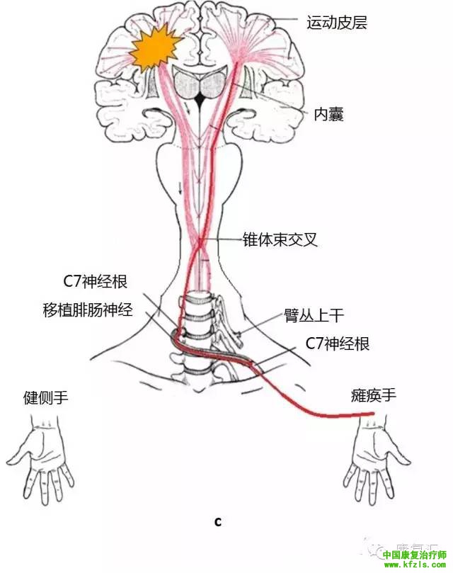 神经损伤