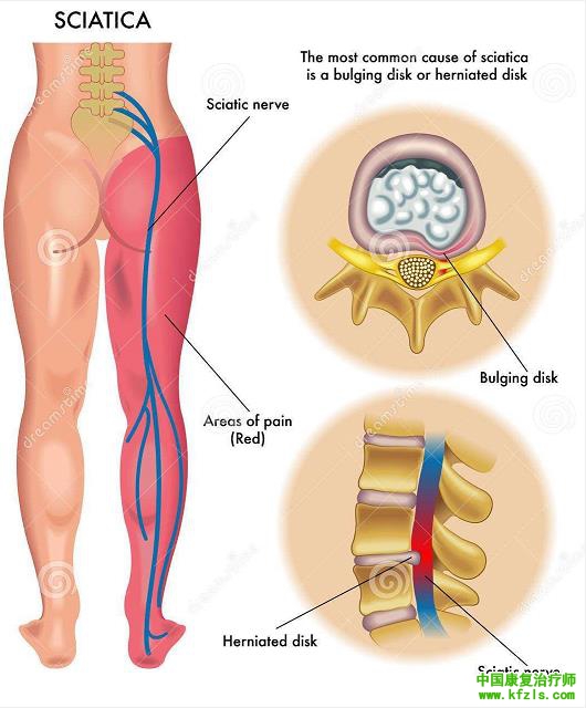 坐骨神经痛