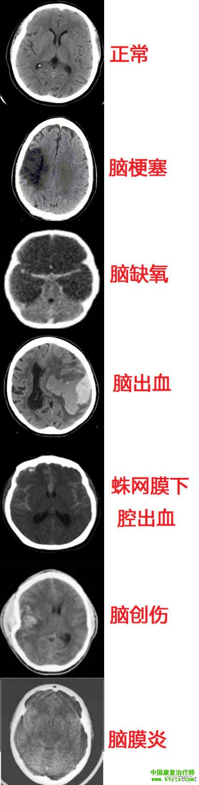 脑病的CT