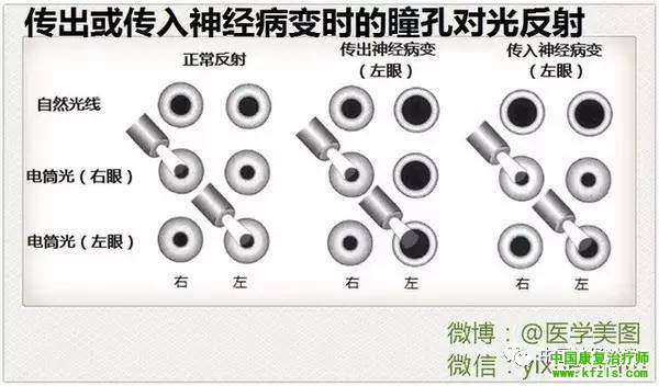 瞳孔对光反射