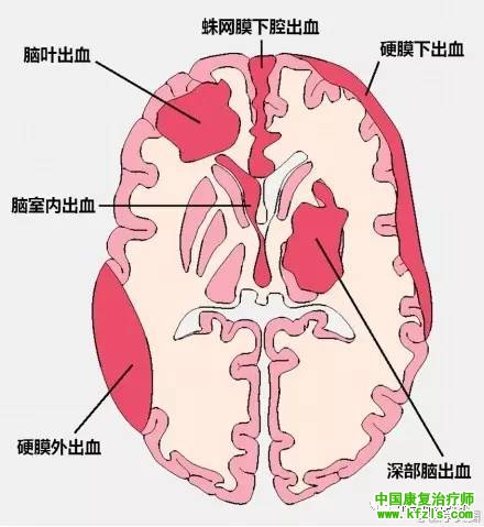 各种颅内出血