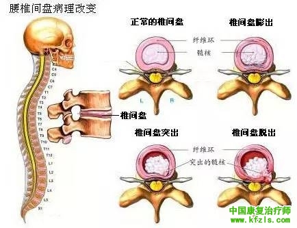 腰椎间盘突出