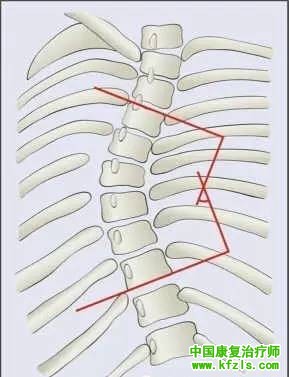 脊柱侧弯的康复训练
