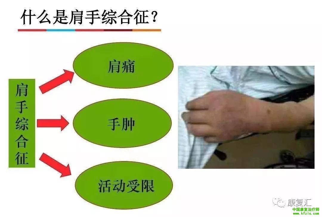 肩手综合征临床康复治疗方案