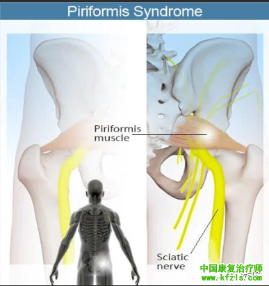 梨状肌综合征的解剖分析与康复治疗