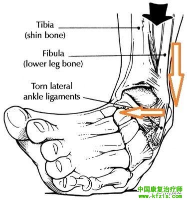 习惯性崴脚危害和康复训练方法