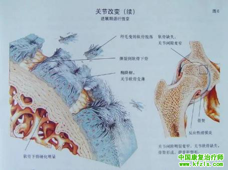 骨关节炎的治疗